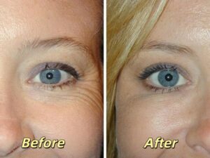 filler dermal filler for eye round filling 