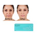 skyden dermal filler comparison