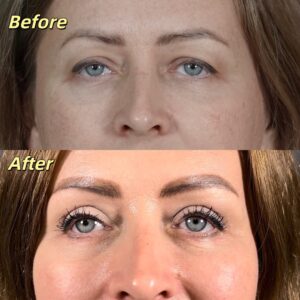 filler dermal filler for face antiaging