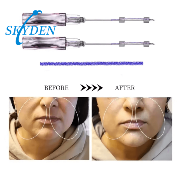 skyden pdo mesh threads filling face