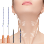 skyden pdo screw for neck