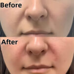 skyden pdo threads before and after